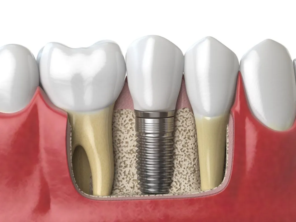 benefits of dental implants
