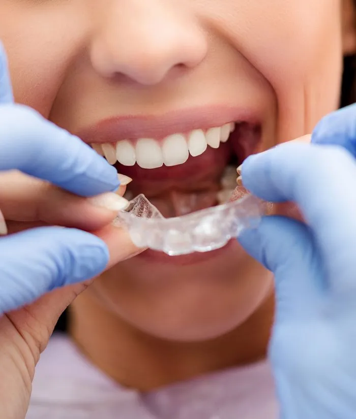 Invisalign-Treatment Invisalign Treatment 700x825