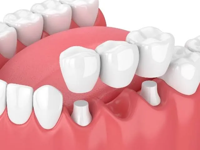 Dental Bridge