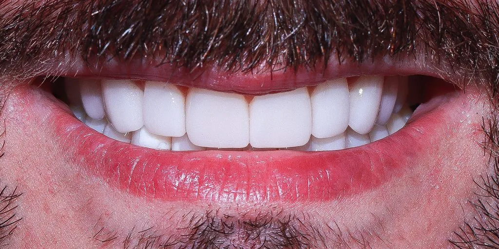02 Porcelain Veneers Christopher After 1024x511