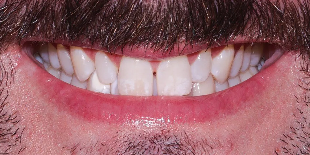 02 Porcelain Veneers Christopher Before 1024x511