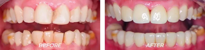 Chipped Teeth 003