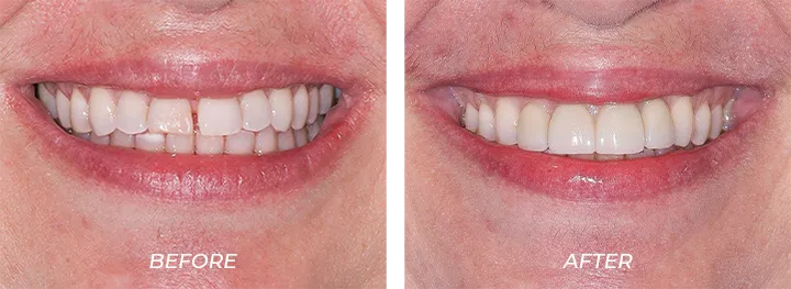 Chipped Teeth Cynthia Hogwood