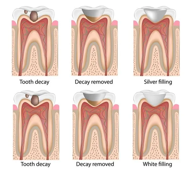 Dental Filling Step X Step 02