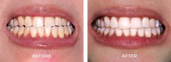 Discoloring Tracey