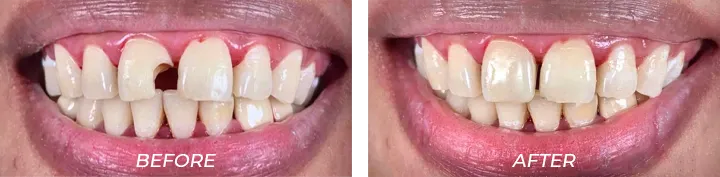Fillings 001