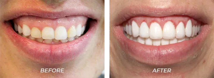 Gummy Smile Audrey