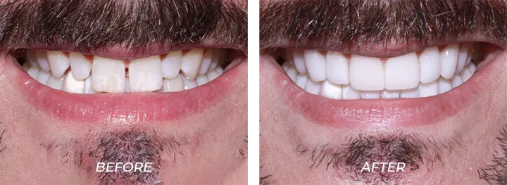 Long Teeth 01