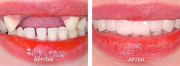 Missing Teeth 01