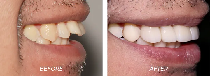 Protruded Teeth 001