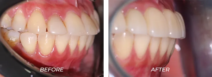 Protruded Teeth 002