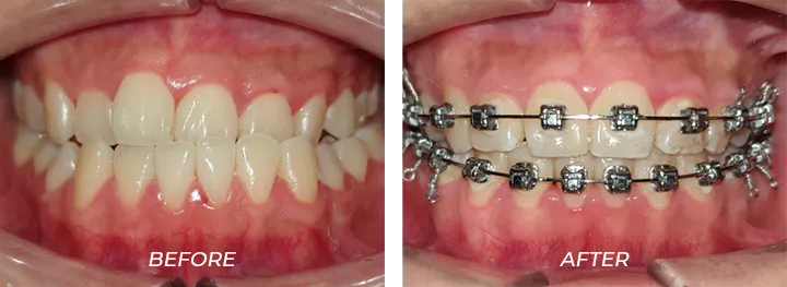 Protruded Teeth 003