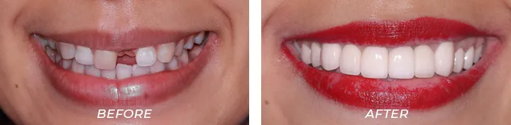 Dental Implant154587856