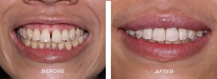 Invisalign154586658