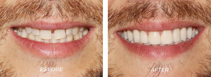 Porcelain Veneers04765