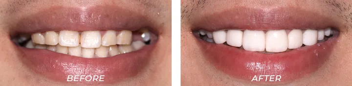 Veneers1545856