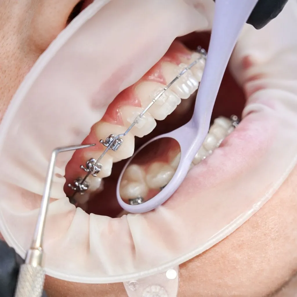 Common Misconceptions About Braces