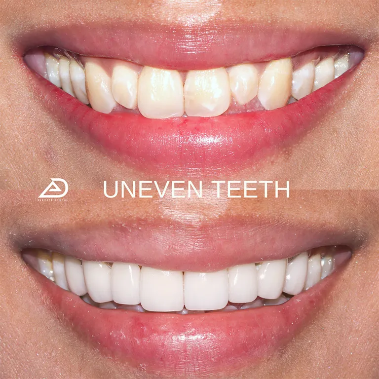Veneers1